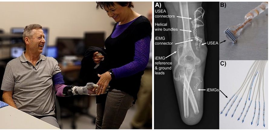 Human subject with an advanced prosthetic arm shaking his wife's hand, and a radiography of implanted electrodes, and optical pictures of electrodes. 